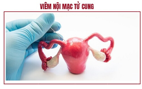 Viêm nội mạc tử cung